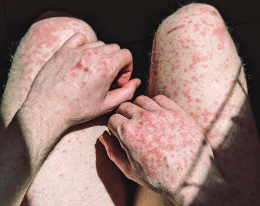 examen-de-laboratorio-clinico-VDRL